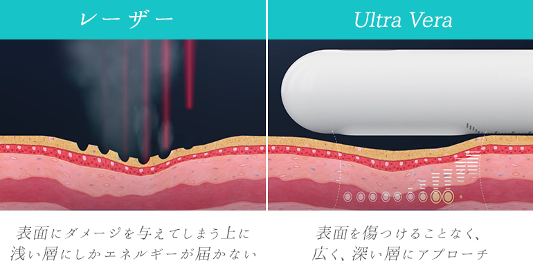 レーザー治療とUltra Veraの違い