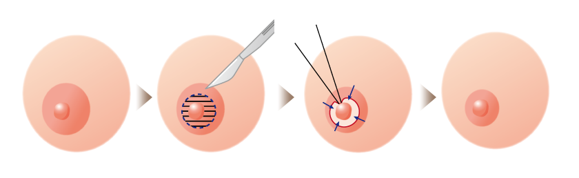 乳首の周りを切って傷跡が目立たなくなる方法