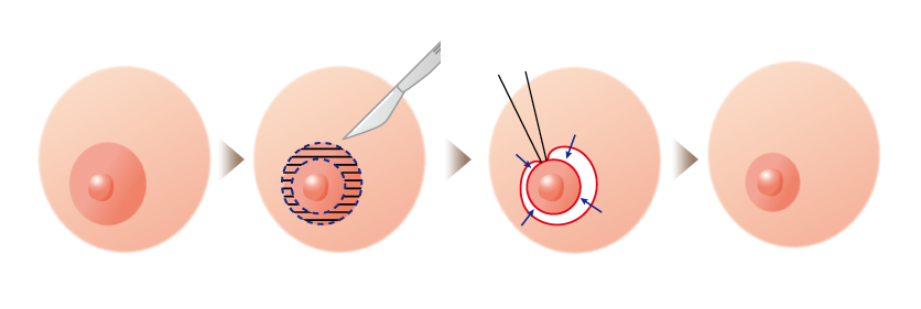 乳輪の外側を切ってサイズを最も小さくできる方法