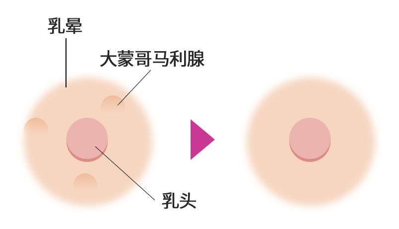 肥大化したモントゴメリー線