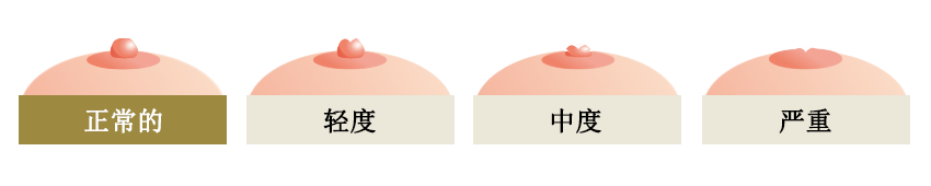 陥没乳頭は軽度・中度・重度の3パターンあります