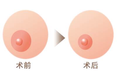 最大50％乳輪のサイズを小さくすることができます。