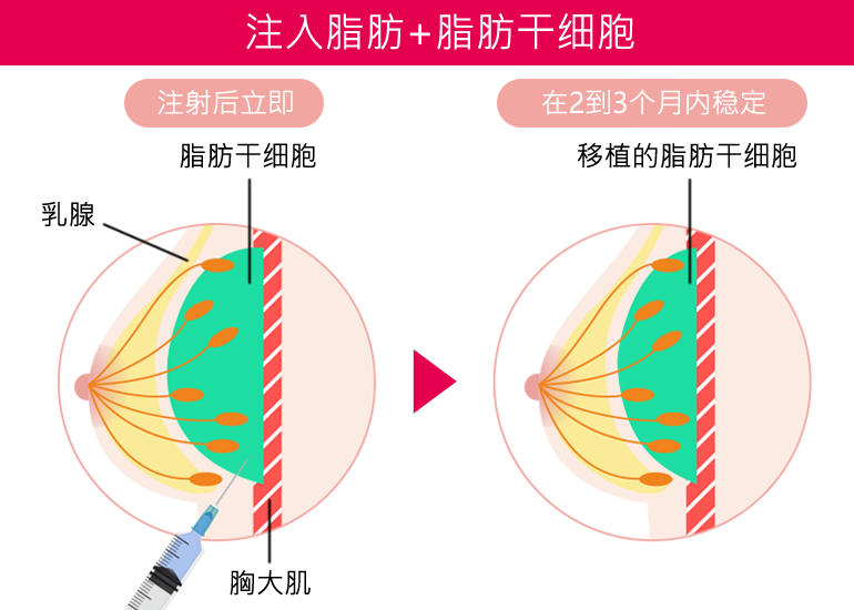 脂肪+脂肪肝細胞を注入