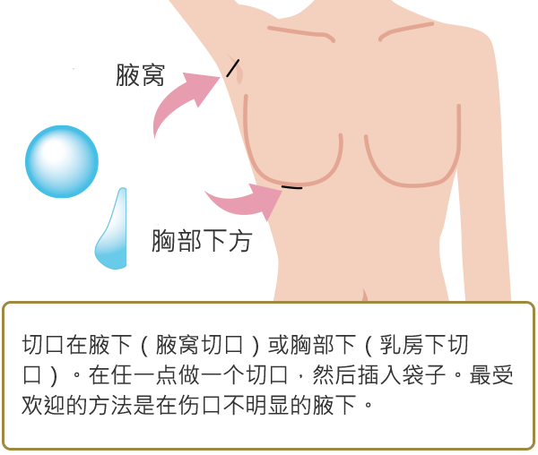 切開の長さはごくわずかなので目立たない