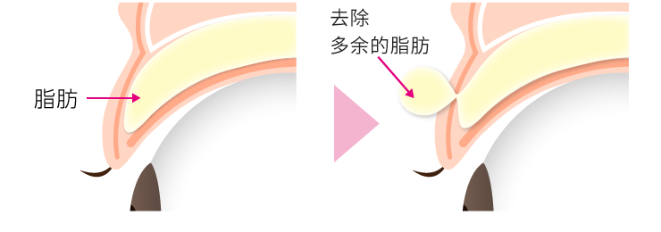 まぶたの余計な脂肪を取り除きます