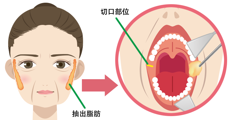 脂肪を引っ張り出します