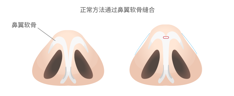 鼻翼軟骨縫縮による通常法