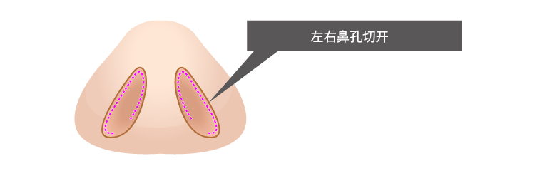 左右の鼻の穴の中を切開