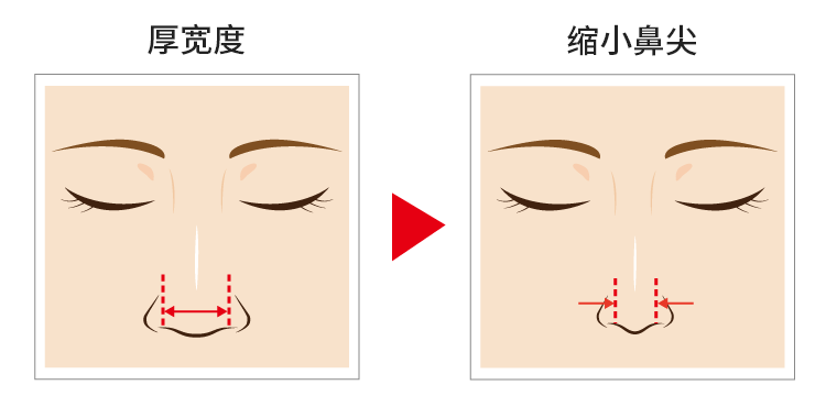 太い鼻先の幅を狭くする