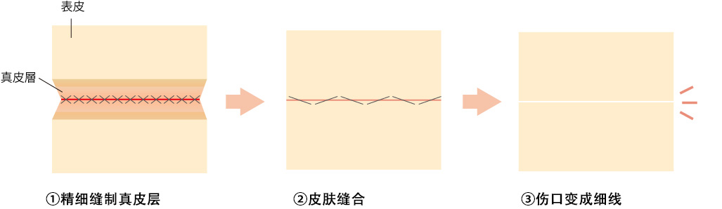 傷跡は初期は赤い線として目立ちますが、徐々に白い線になってなじんでいきます。